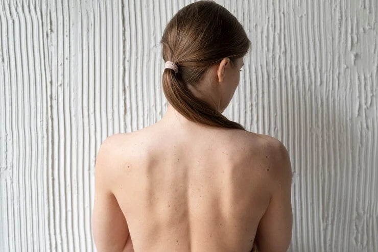 women with back acne problem