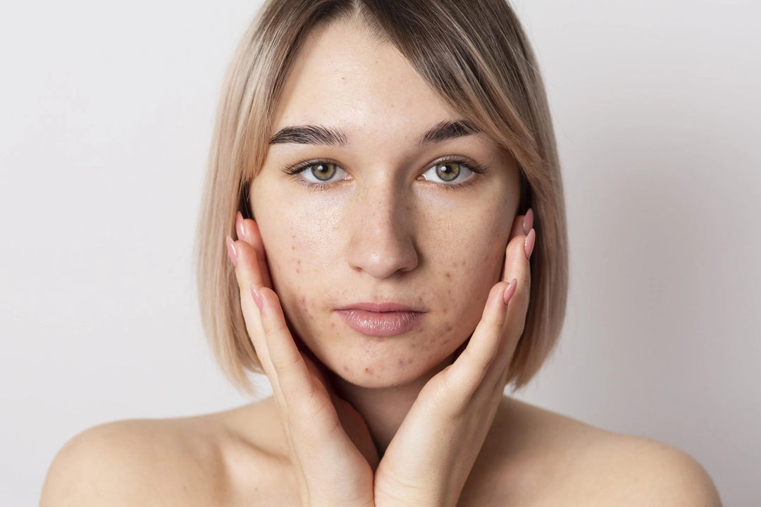 Dark Spot Makes Your Faces Dull? Here’s How To Deal With Them!