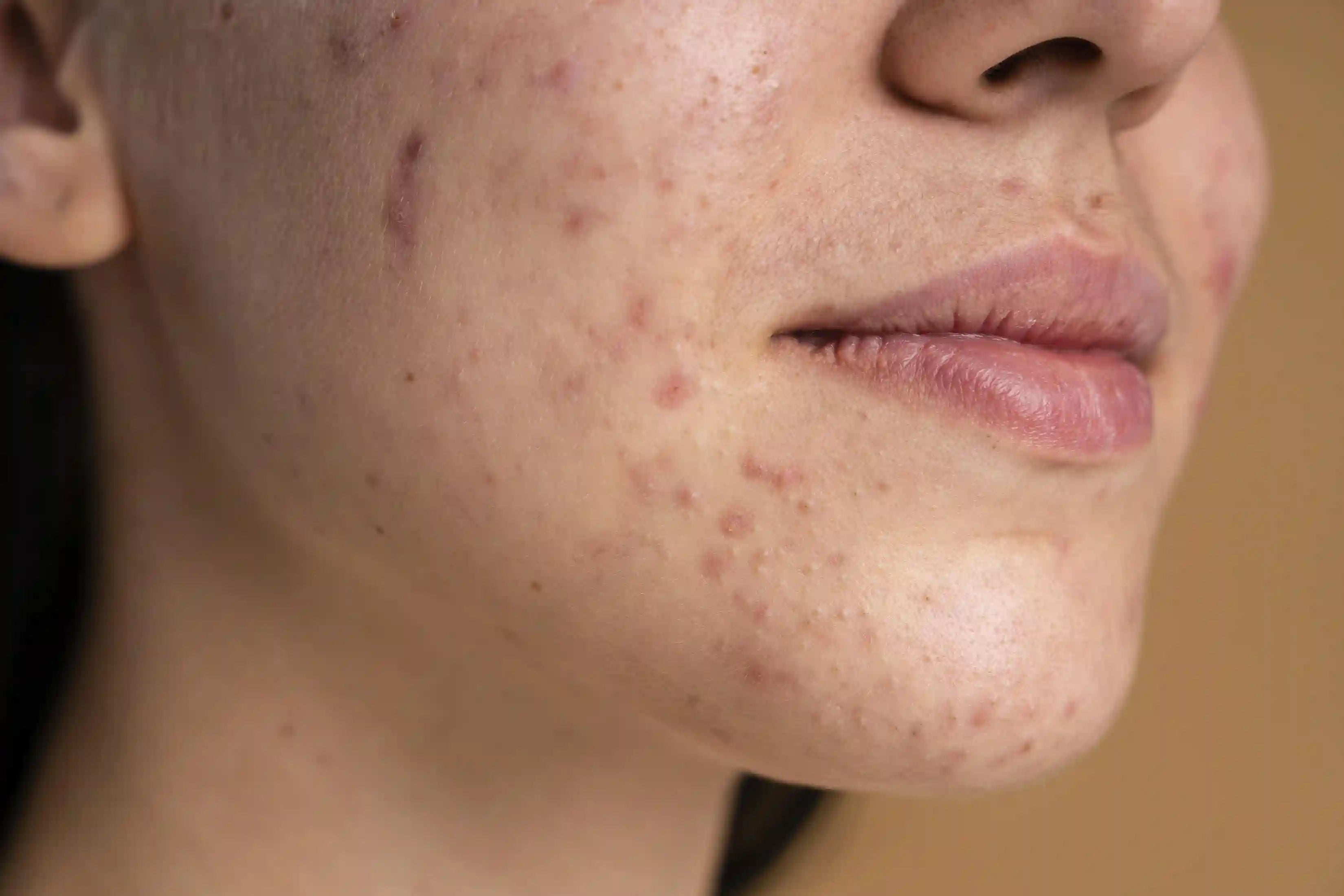 https://id.loccitane.com/cdn/shop/articles/confident-young-woman-with-acne-close-up.webp?v=1756723591