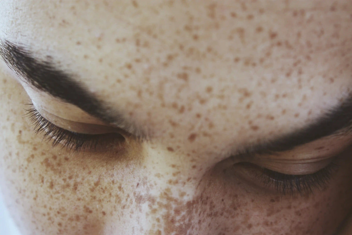 Block Spots 5 Causes of Black Spots on the Face and Their Factors | L'Occitane ...