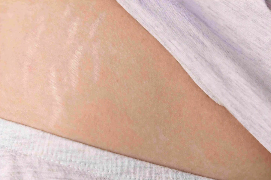 stretch mark on women's waist