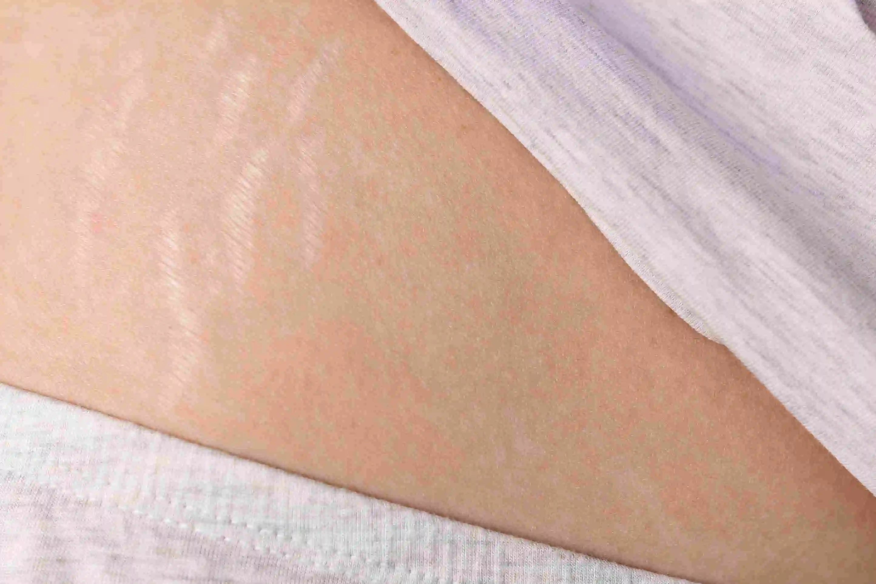 stretch mark on women's waist